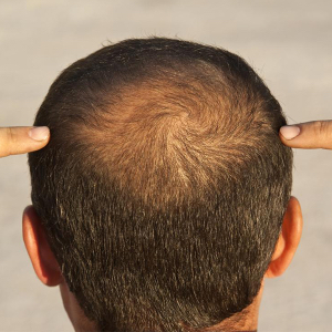  MEN: STOP LOSING YOUR HAIR TODAY!