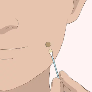  GET RID OF YOUR MOLES AND SKIN TAGS